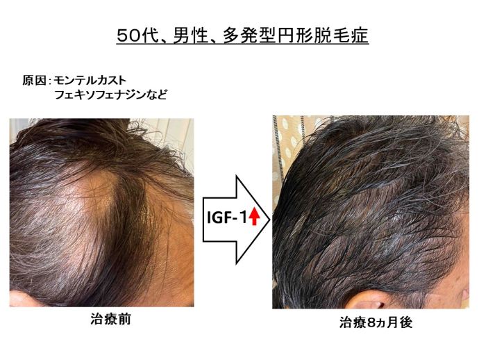 円形脱毛症　病院